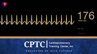 Taquicardia Supraventricular [upl. by Nylasoj245]