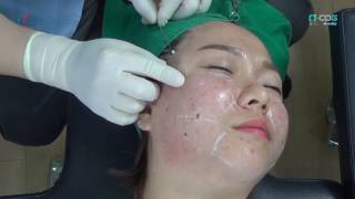 Non surgical Full Facelift PDO thread technique  NCog amp NScaffold [upl. by Edmunda951]