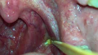 Tonsil Stone Removal By Yourself [upl. by Iret]