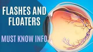 Flashes Floaters Posterior Vitreous Detachment vs Retinal Detachment [upl. by Nnanaej147]