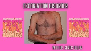 Excoriation Disorder [upl. by Kerr]