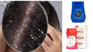 sir ki Khushi or dandruff ka ilaj Urdu handi Conaz lotion shampoo sulsun blue shampoo [upl. by Rebba561]