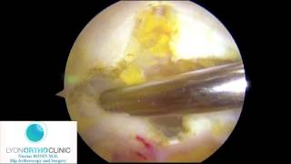 Hanche arthroscopie  Décompression de la bandelette iliotibiale par voie sous cutanée [upl. by Pheni]