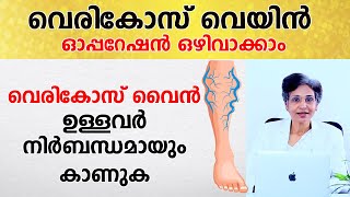 വെരികോസ് വൈൻ ഉള്ളവർ നിർബന്ധമായും കാണുക  Varicose Vein  Avoid Surgery  Arogyam [upl. by Asirram]