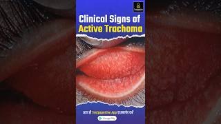 Clinical signs of active trachoma trachoma Clinicalsigns eye ophthalmology testpaperlive [upl. by Nagorb387]