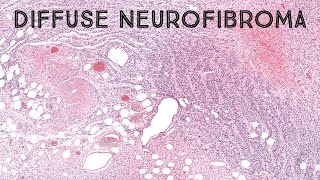 Diffuse neurofibroma in neurofibromatosis NF1 round nuclei amp tiger stripe pattern pathology [upl. by Kiyohara993]