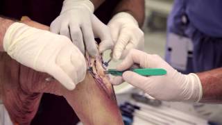 Patellar Tendon Graft [upl. by Alika]