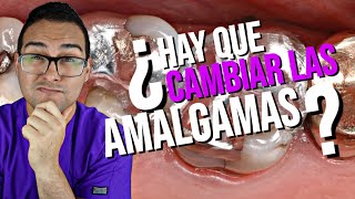 RESINA 💎 Vs AMALGAMA DENTAL🌡️ ¿Debo CAMBIAR 🤔 PREGUNTAS Y RESPUESTAS [upl. by Odnomar]