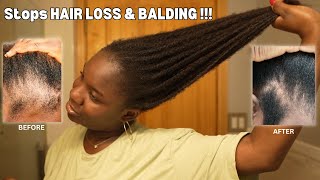 Use This Once a Week and Your Hair Will Never Stop Growing DIY for HAIR LOSS amp BALDING‼️ [upl. by Hilary]