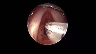 balloon dilation coblation assisted for grade 2 subglottic stenosis [upl. by Atinniuq]