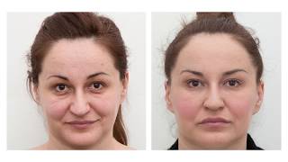 The results of dermal fillers before and after [upl. by Caroline]