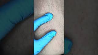 Watch Electrolysis Now Zap Hairs with Me [upl. by Efeek]