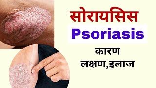 psoriasis in hindi  Psoriasis skin disease  skin disease nursing gnm 2nd year [upl. by Rebna]