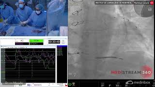 PA CardioMems Implantation in Patient with with Decompensated HF and Elevated NTproBNP [upl. by Griselda]