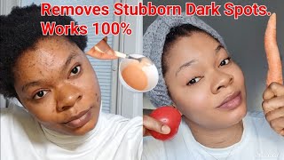 How to remove dark spotsacne amp pimples You will forever look YOUNGER skincare diy darkspots [upl. by Erinna]