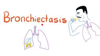 Bronchiectasis [upl. by Anirbed16]