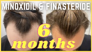 Minoxidil amp Finasteride  6 Month Update  Christopher Painter [upl. by Balkin270]