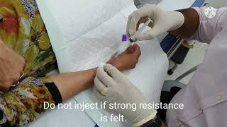 WRIST DEQUERVAINS STEROID INJECTION DR PRADEEP BALA [upl. by Isabel]