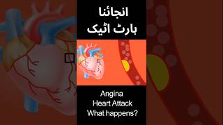 Angina vs heart attack [upl. by Elleimac686]