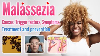 Malassezia causes conditions symptoms trigger factor treatment and prevention [upl. by Lucilla]