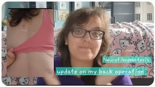 Update Neurofibromatosis back operation Neurofibromatosis afteroperation postoperation [upl. by Rafaelle260]