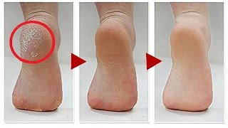 How to Get Rid Of Calluses On Feet  6 Natural Home Remedies to get rid of calluses on feet [upl. by Ennahteb]