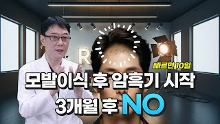 모발이식 후 암흑기 시작은 23개월 후에 시작되지 않습니다 더 빨리 시작됩니다 [upl. by Arahk]