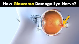 How Glaucoma Damages The Eye UrduHindi [upl. by Heins974]