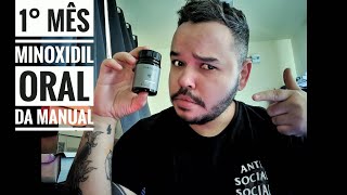 🔴 1 Mês de Minoxidil Oral da Manual Comprimido 💊  O que mudou É Bom [upl. by Kapoor]