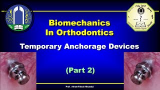 Biomechanics of TADs with Clinical Consideration Part 2 [upl. by Nuarb]