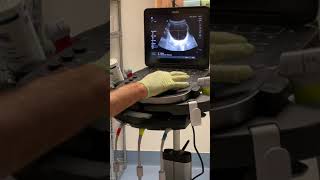 Bladder Scan Procedure [upl. by Luo951]