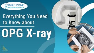 Everything You Need To Know About OPG XRay [upl. by Stefanac]