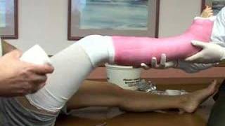 application of a long leg cast [upl. by Novad]