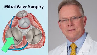 Mitral Valve Surgery What Should Patients Know Interview with Dr Vaughn Starnes [upl. by Gide677]