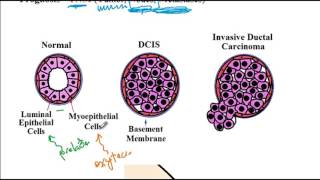 Breast disorders fibrocystic disease mammary duct ectasia USMLE Step 1 USMLE ACE [upl. by Godwin466]