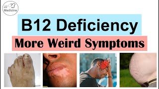 Vitamin B12 Deficiency Weird Symptoms – Part 2 Types of Headaches Gastrointestinal and Others [upl. by Anialem]