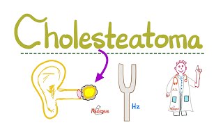 Hearing Loss Deafness  Cholesteatoma  Causes Symptoms Diagnosis amp Treatment  ENT  Pathology [upl. by Erehpotsirhc]