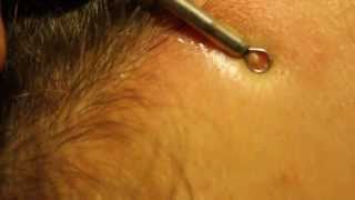 Blackhead extraction  forehead zit [upl. by Eelrefinnej]