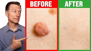 How to Rid Skin Tags and Warts Within 24 Hours  Dr Berg on Skin Tag Removal [upl. by Ayiram223]