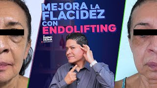 MEJORA LA FLACIDEZ FACIAL CON ENDOLIFTING  Consejos de un Dermatólogo [upl. by Fish684]