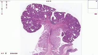 Tubular adenoma  Colon  Histopathology [upl. by Nnylyoj808]