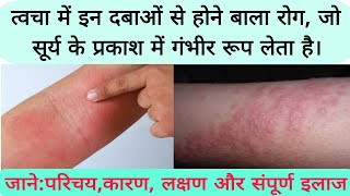 photosensitive eruption eczema disease फोटोसुग्रहित विस्फोट छाजन रोग का कारण लक्षण और संपूर्ण इलाज [upl. by Katrina751]