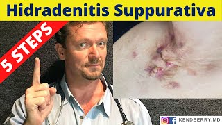 HYDRADENITIS SUPPURATIVA 5 Steps to Reverse HS [upl. by Lodi]