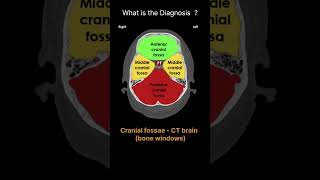 Cranial fossae  CT brain  bone windows CT Brain Anatomy Quiz 5 radiologychannel007 [upl. by Riti73]