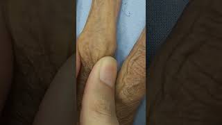 Bouchard Nodes  Pip joint  Osteoarthritis  Bony outgrowths clinicalskills [upl. by Joanne]