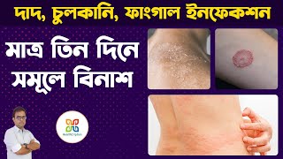 6 Home Remedies for Itching Problem In Private Parts Skin Fungal Infection দাদহাজাচুলকানি । [upl. by Oruasi33]