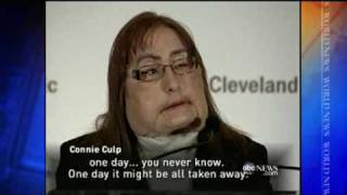 Face Transplant Recipient Shows Her Face  CONNIE CULP  ABC News [upl. by Ajan]