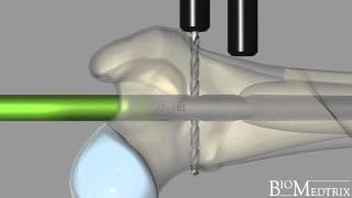 ILoc® IM Fixator Interlocking Nail  BioMedtrix [upl. by Asaeret964]