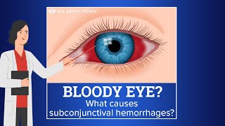 Subconjunctival Hemorrhage Blood in Eye [upl. by Cunningham]