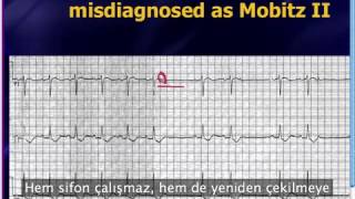 Mattu EKG Vakası  İletilmeyen PAC mı Mobitz II mi  22 Temmuz 2013 [upl. by Nalo]